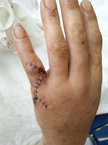 小萨遭遇拇指韧带撕脱性骨折的相关图片